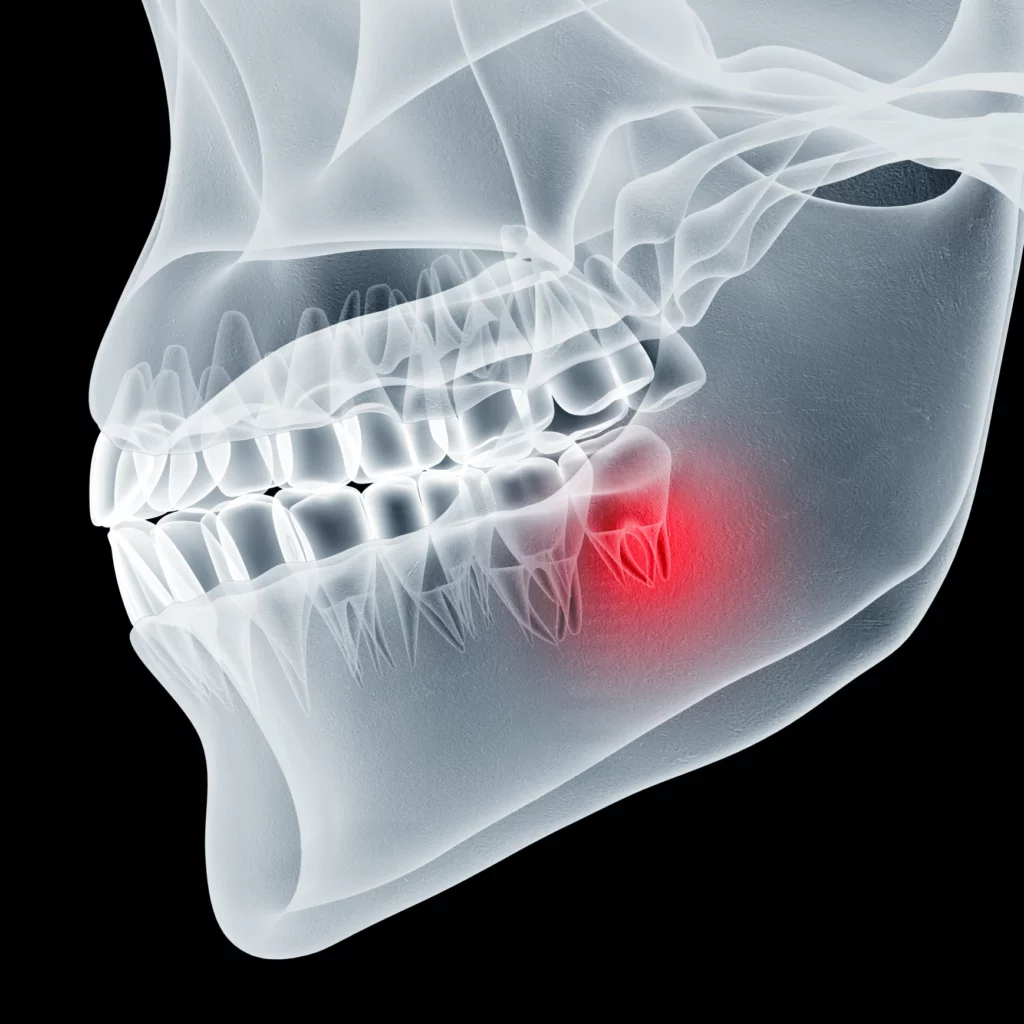 wisdom teeth removal in Bartow, FL