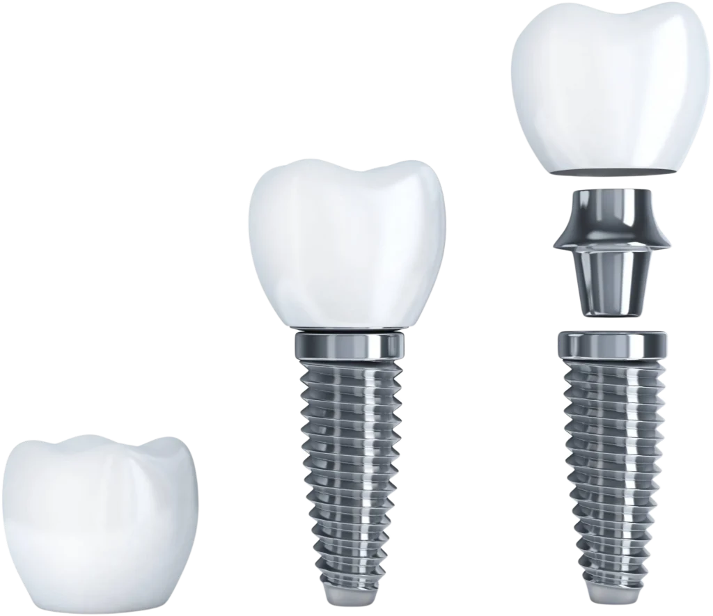 model of a single tooth dental implant, including the implant body, abutment, and tooth crown