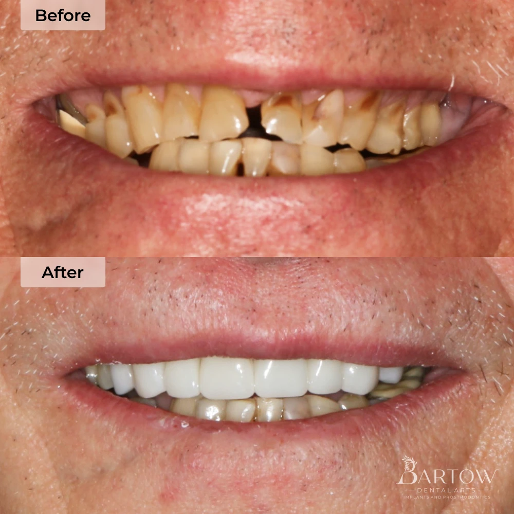 dental crowns before and after