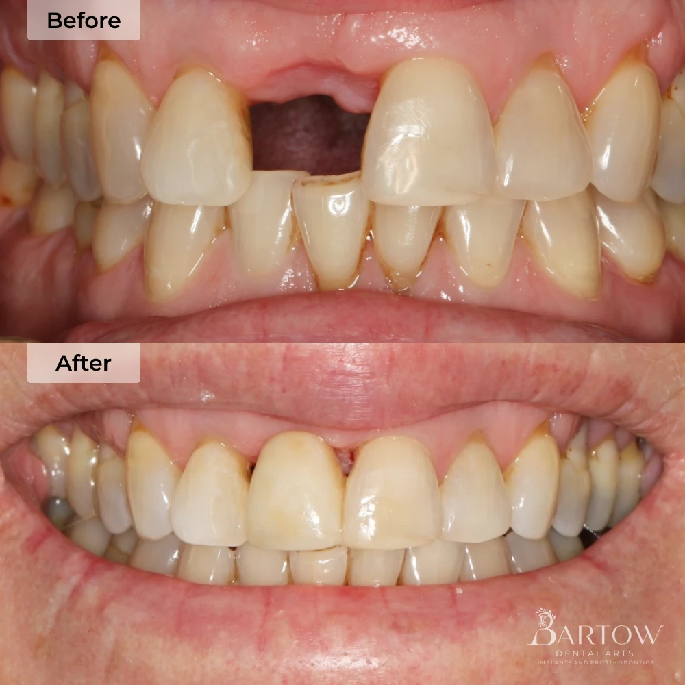 before and after dental implants