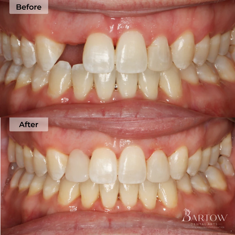 before and after dental implants
