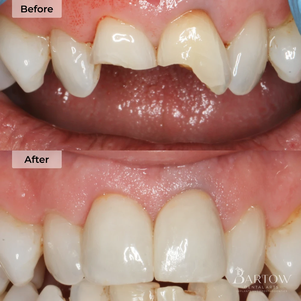 dental crowns before and after