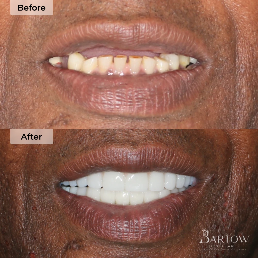 before and after dental implants in Bartow, FL