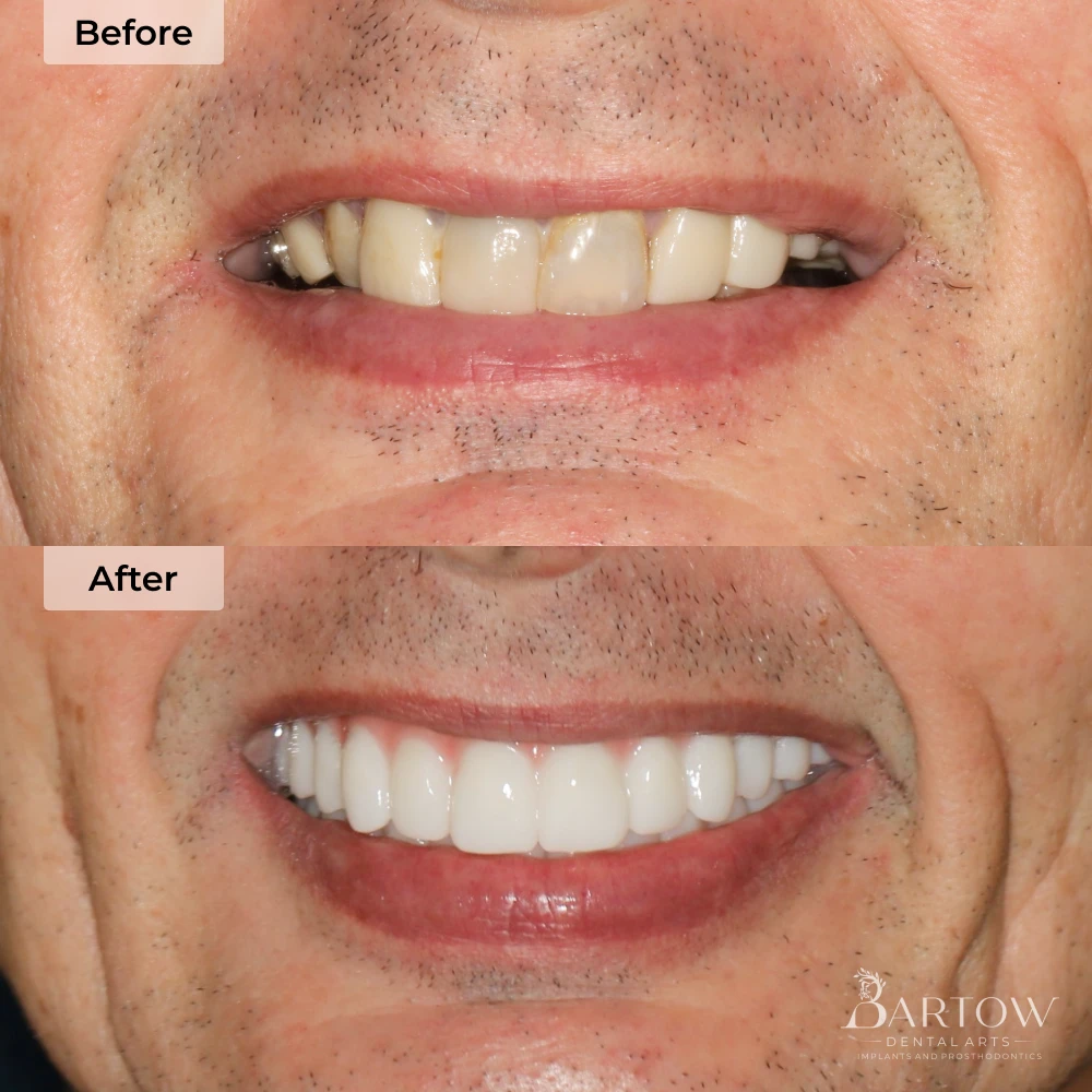before and after dental implants in Bartow, FL