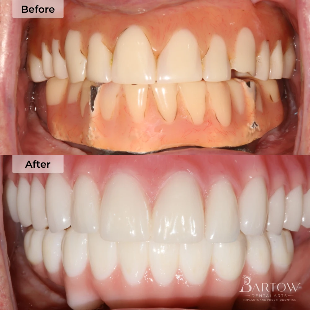 before and after full mouth dental implants in Bartow, FL