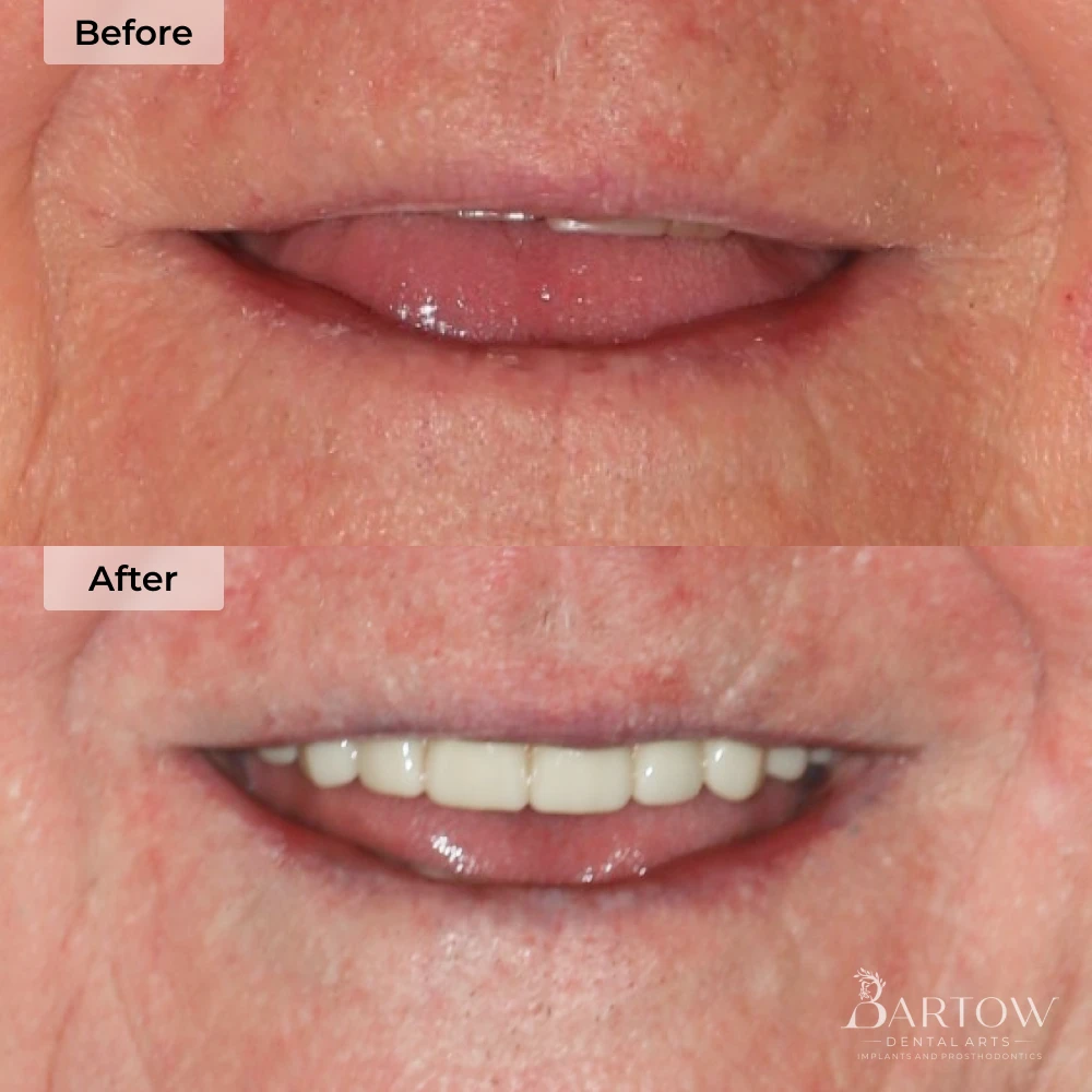 before and after dental implants