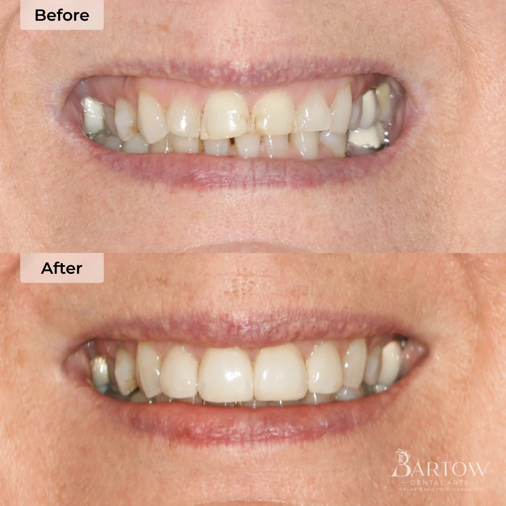 veneers before and after