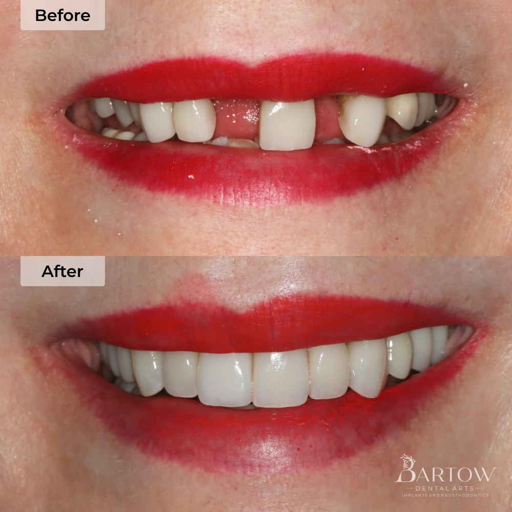 before and after dental implants