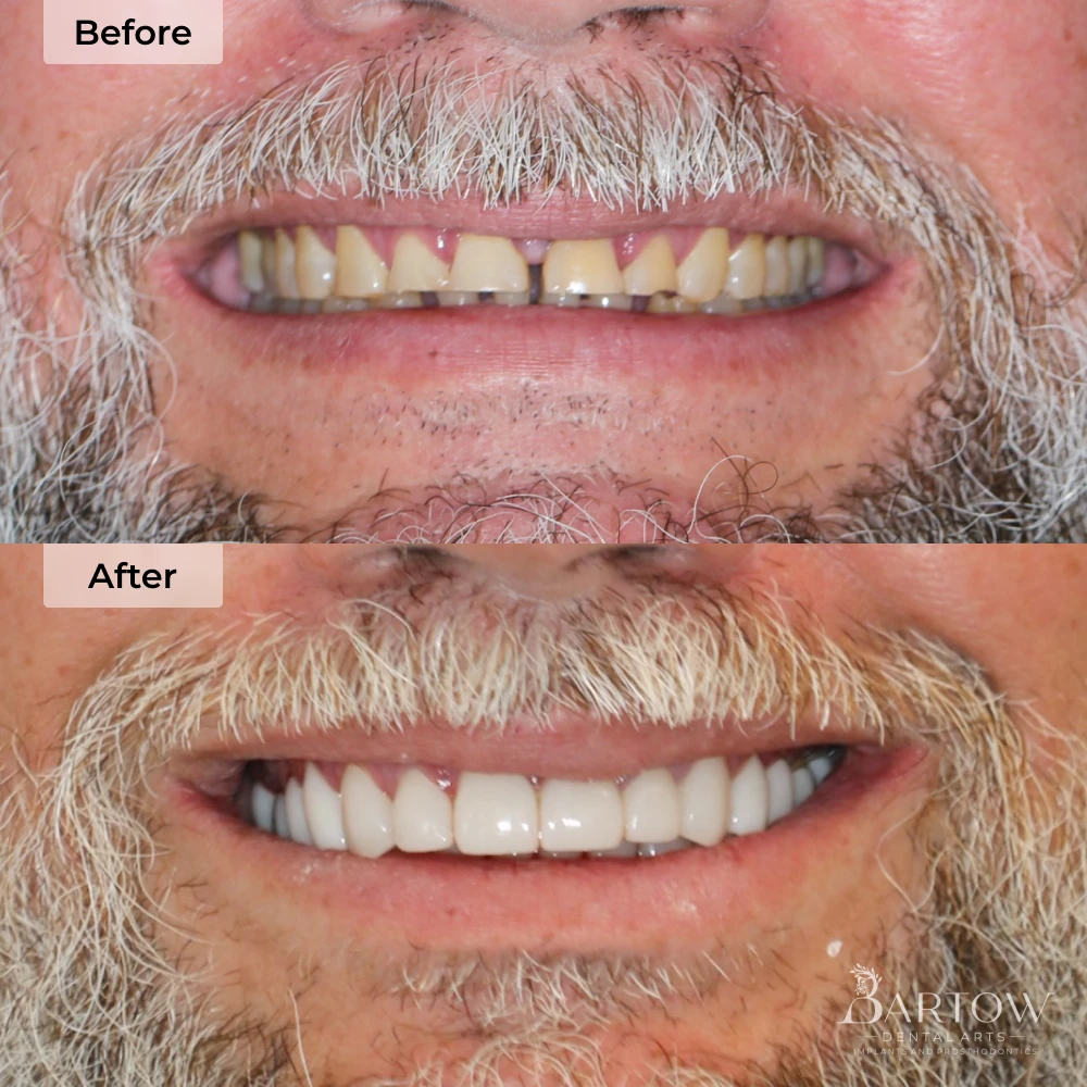 veneers before and after